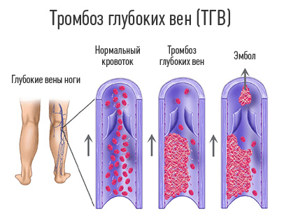 Народные методы лечения тромбофлебита